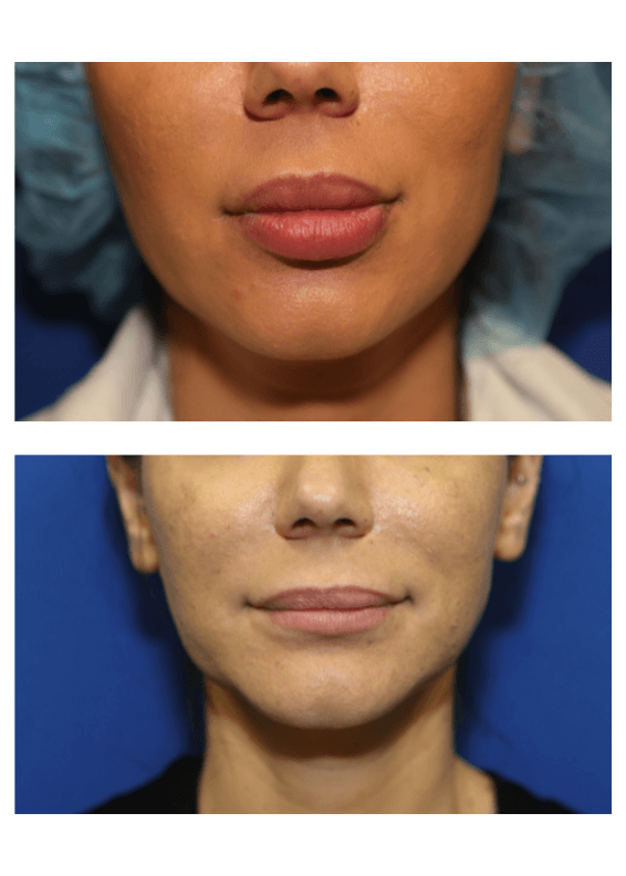 silicone removal lips
